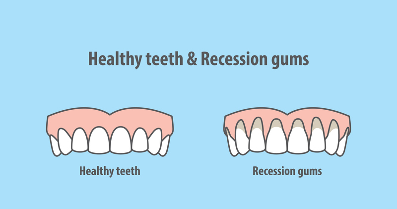 Understanding and Preventing Gum Recession