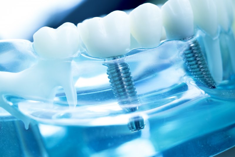 The Latest Advances in Dental Implant Technology