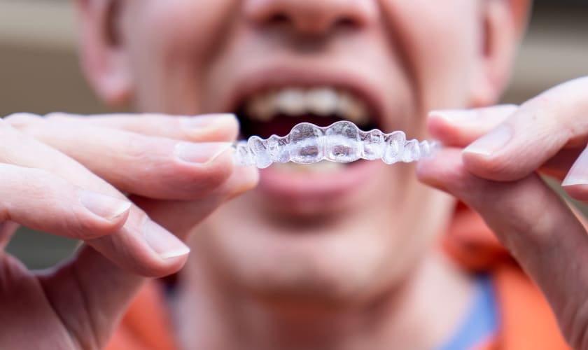 Invisalign: What You Need to Know Before Starting