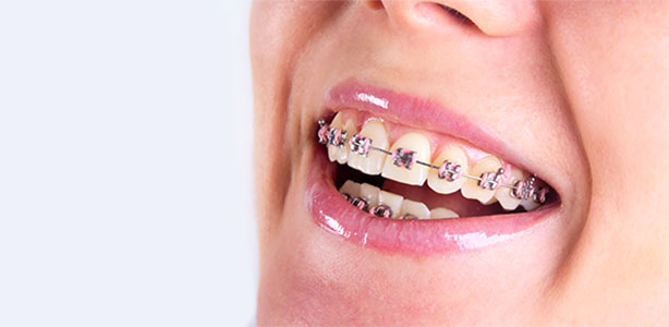 Tips for Maintaining Oral Hygiene with Braces