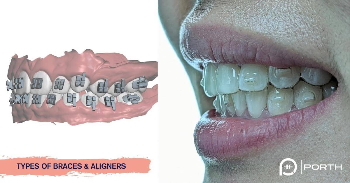 How to Care for Your Teeth with Clear Aligners