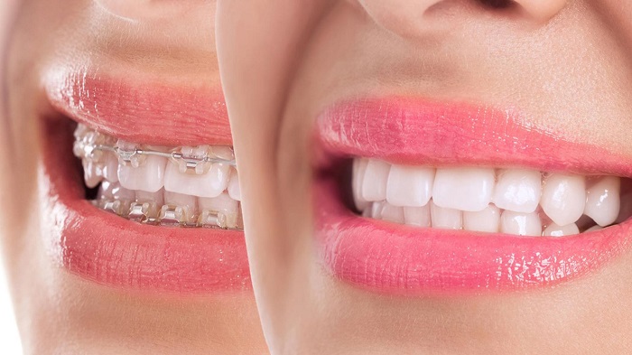 Unlocking the Perfect Smile Braces, Aligners, and Cosmetic Dentistry DentalDome