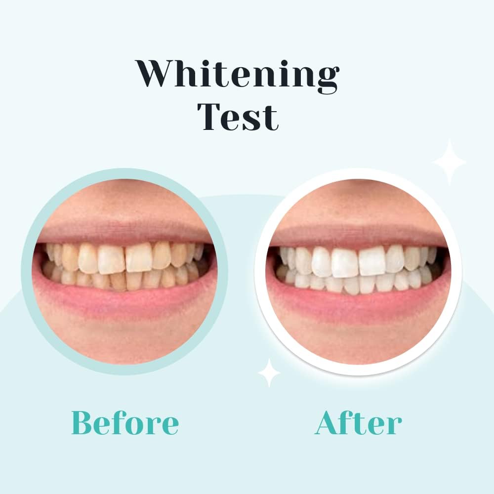 AutoBrush Teeth Whitening Kit with LED Lights, Complete Home Whitening System, 30 Whitening Sessions (White)